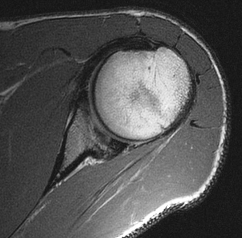 Figure 3 for case Osteochondritis dessicans of the glenoid